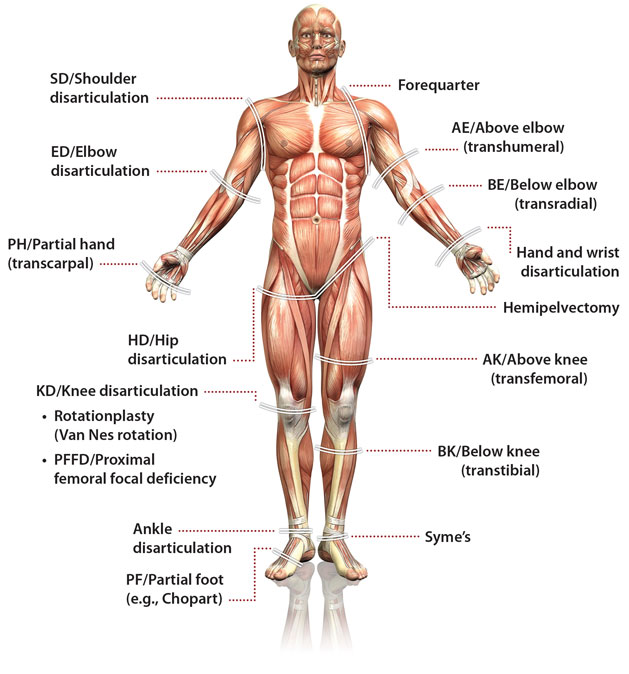 An anatomy-style illustration of a man's body with exposed muscle and includes text indicating the types of amputation levels.