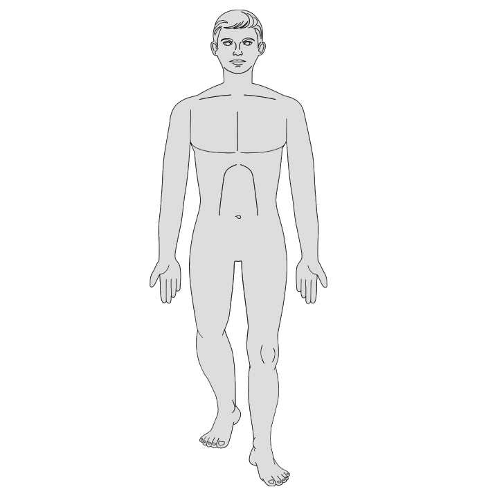 An anatomy-style illustration of a man's body showing a PFFD / Proximal Femoral Focal Deficiency.